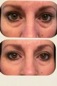 Wilma Schumann Hydrating Collagen Eye Pads (Pack of 5 pairs)